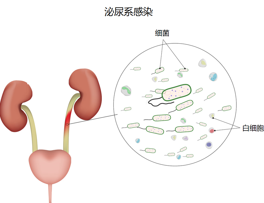 三伏天尿路結(jié)石的“高發(fā)季”，有哪些常見誤區(qū)