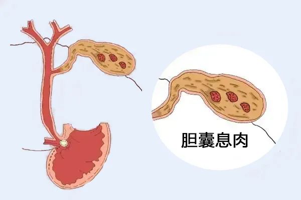 體檢出膽囊息肉，需要擔(dān)心嗎？