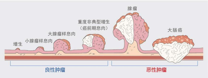 什么樣的腸息肉容易癌變？有一種要特別當(dāng)心！