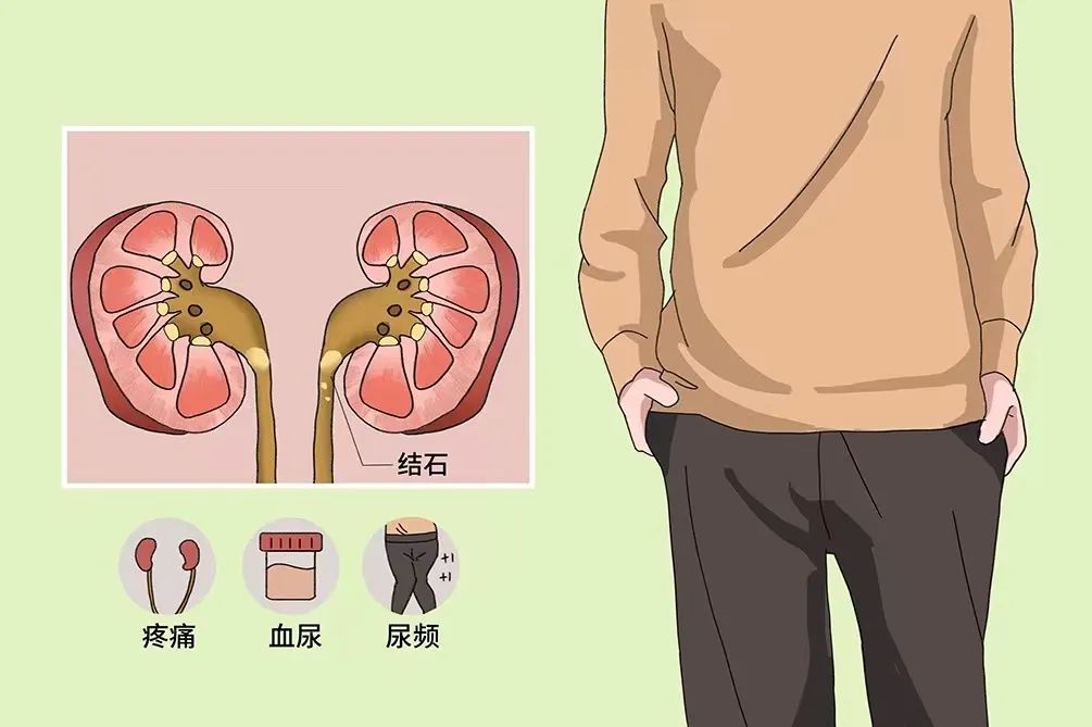 為什么很多人得腎結(jié)石？有2個習慣不要碰，腎會感激你