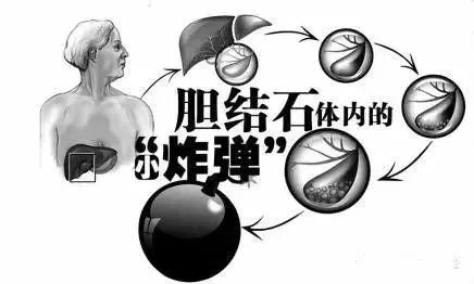膽囊里的小結(jié)石要緊嗎？長大后再處理行不行？