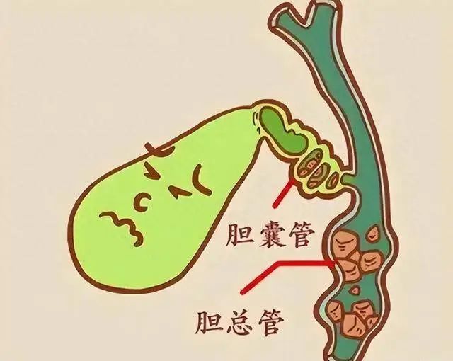 膽囊增大別視若無睹，可能背后潛伏了這幾頭“狼”！
